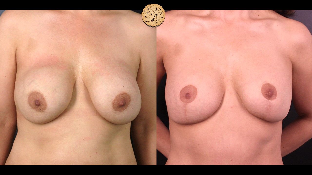 Breast Implant Exchange Before & After