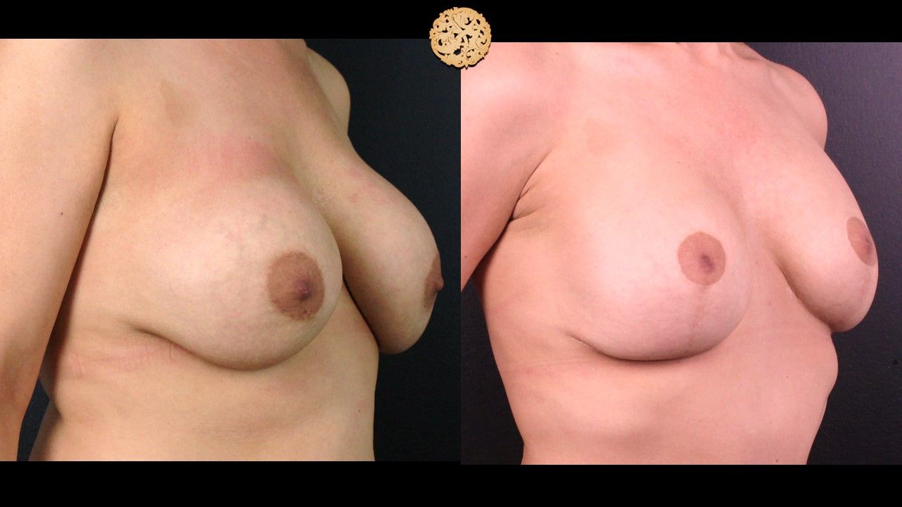 Breast Implant Exchange Before & After