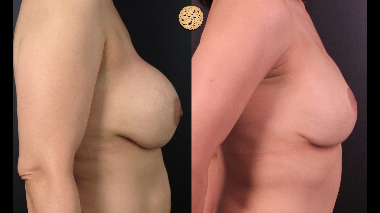 Breast Implant Exchange Before & After