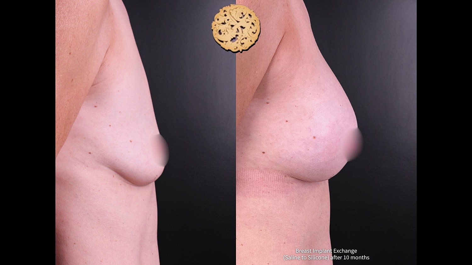 Breast Implant Exchange Before & After