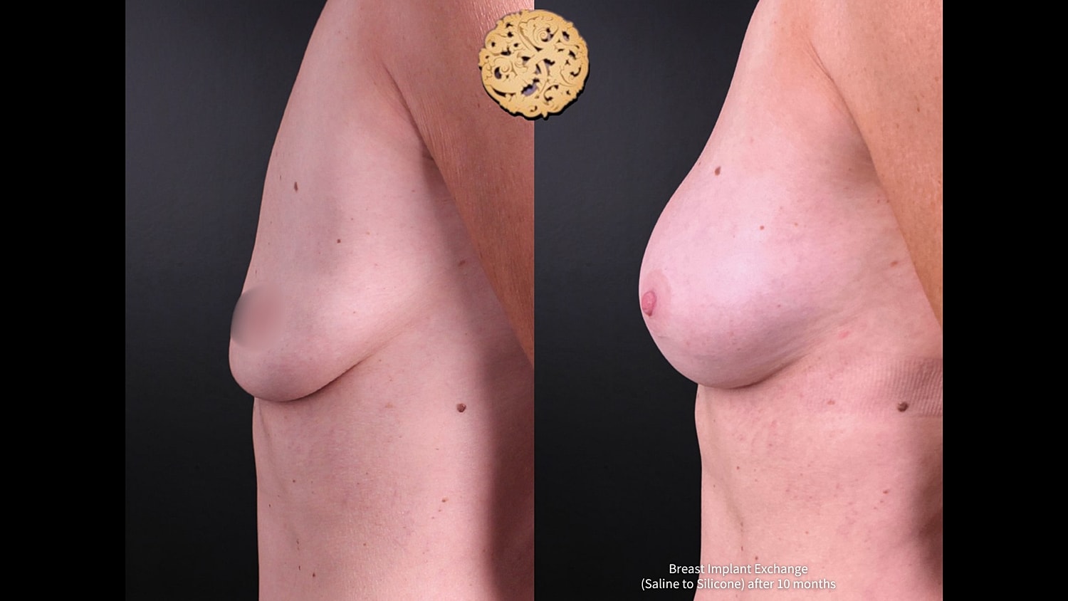 Breast Implant Exchange Before & After