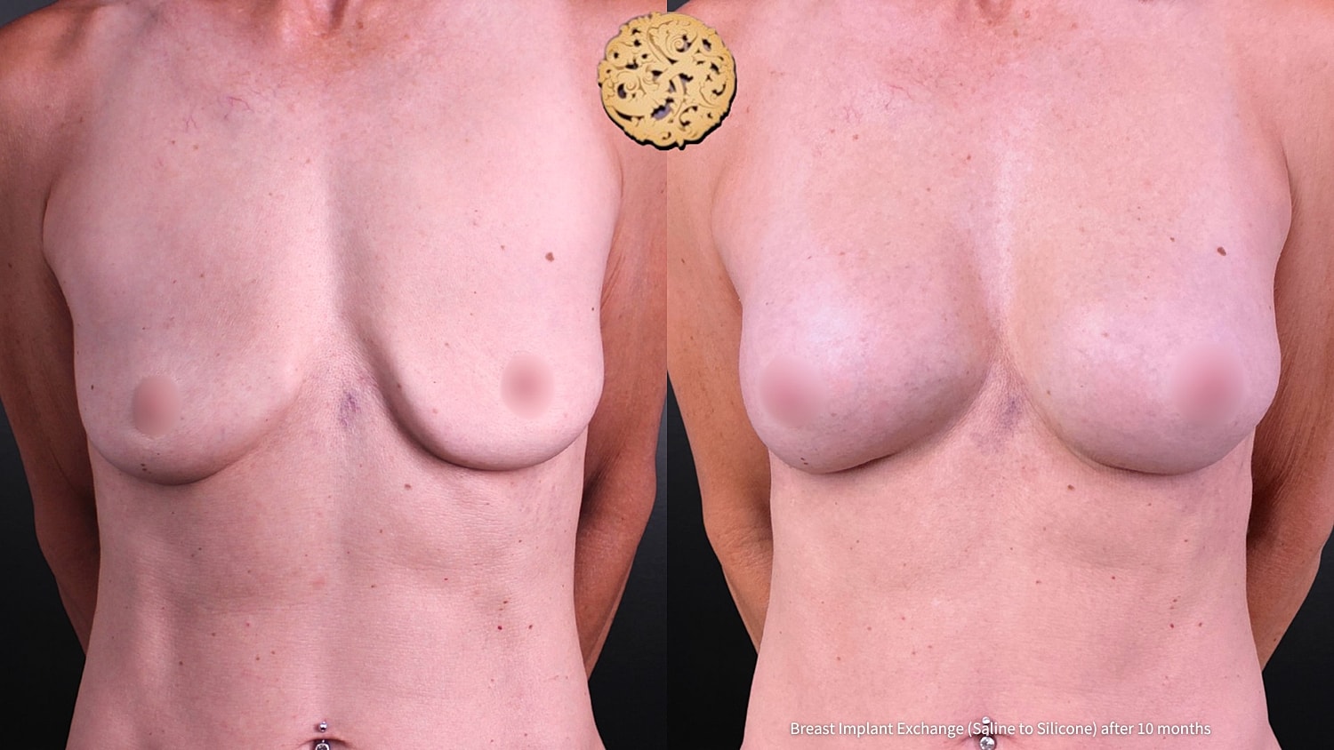 Breast Implant Exchange Before & After