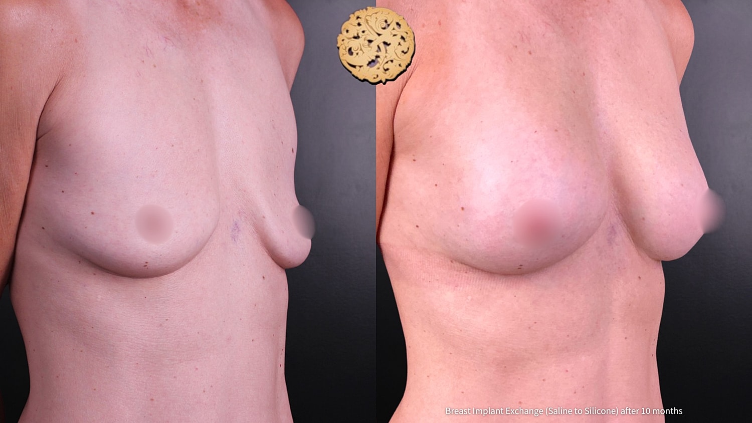 Breast Implant Exchange Before & After