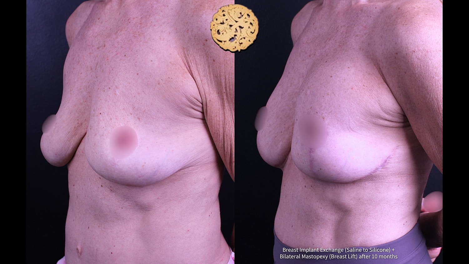 Breast enhancement procedure before and after images.
