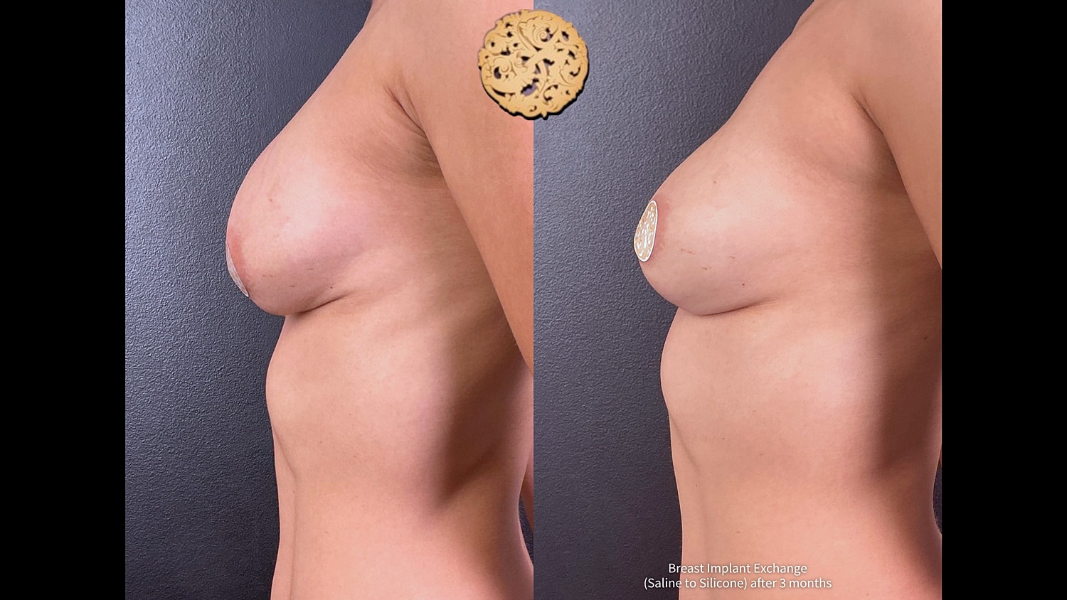 Breast Implant Exchange Before & After