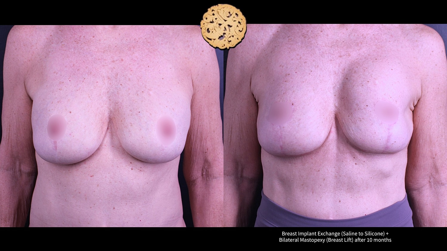 Before and after breast implant surgery images.