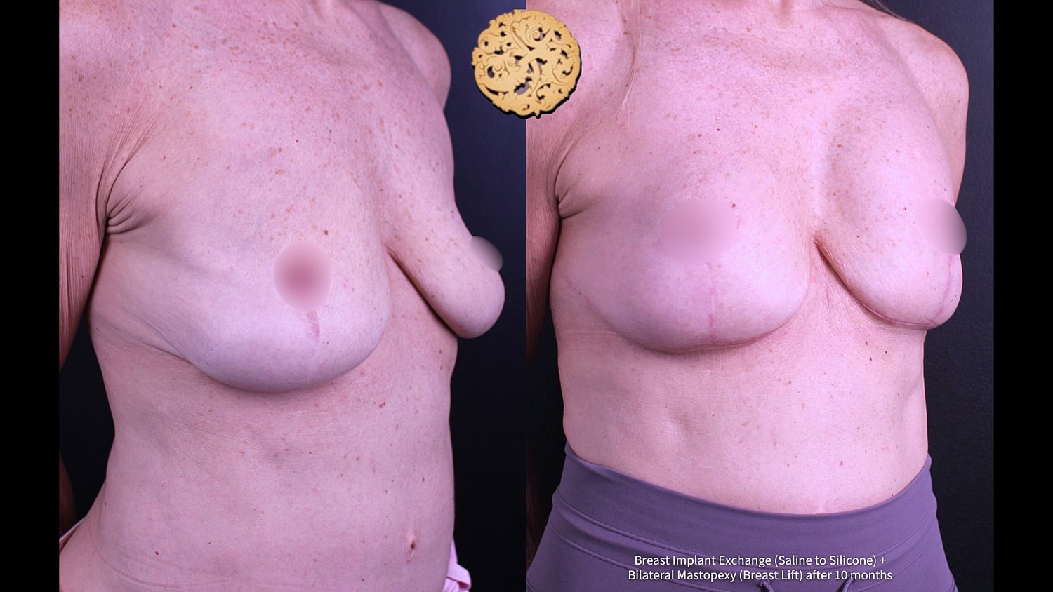 Breast enhancement before and after surgery comparison.
