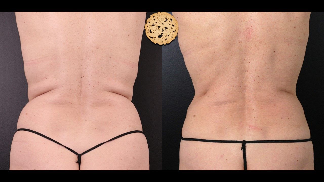 Coolsculpting Before & After