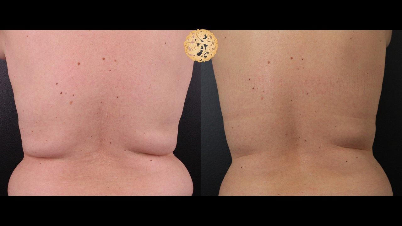 Coolsculpting Before & After