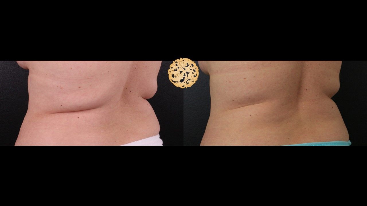 Coolsculpting Before & After