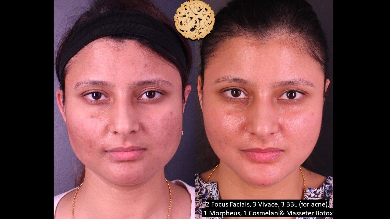 Morpheus8 Face Before & After