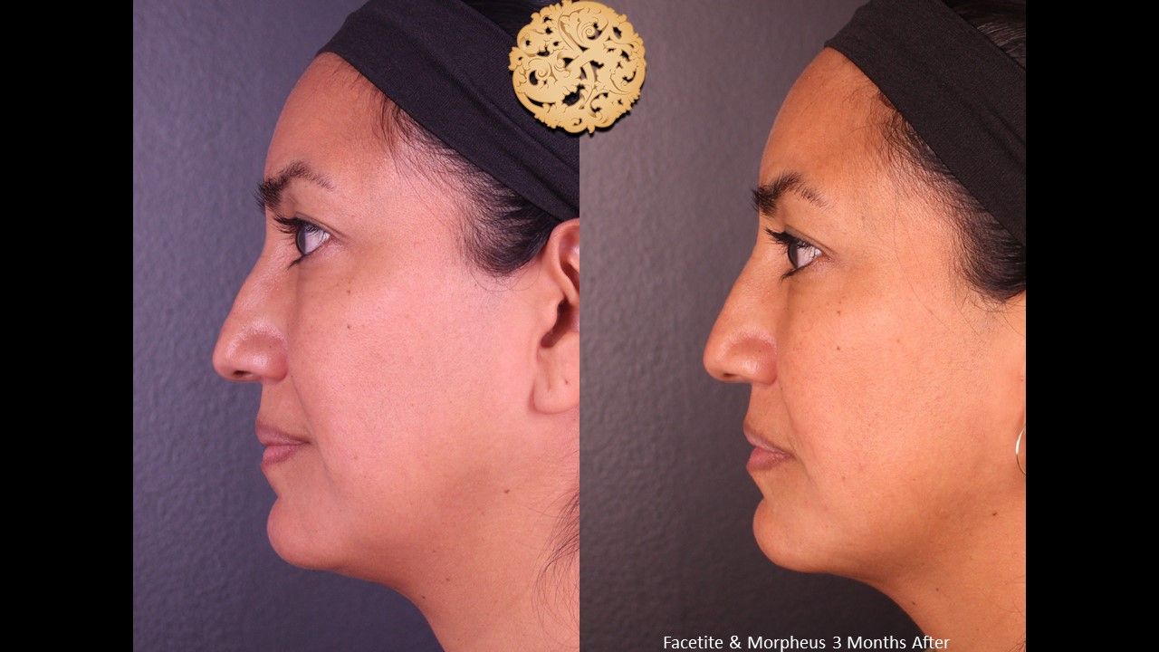Morpheus8 Face Before & After