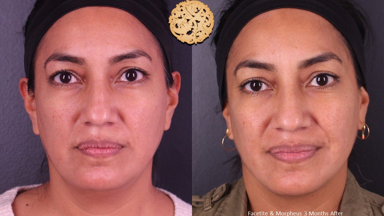 Morpheus8 Face Before & After