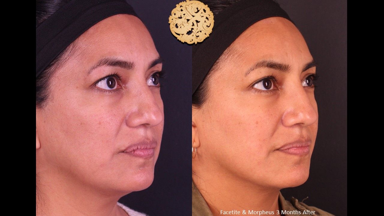 Morpheus8 Face Before & After