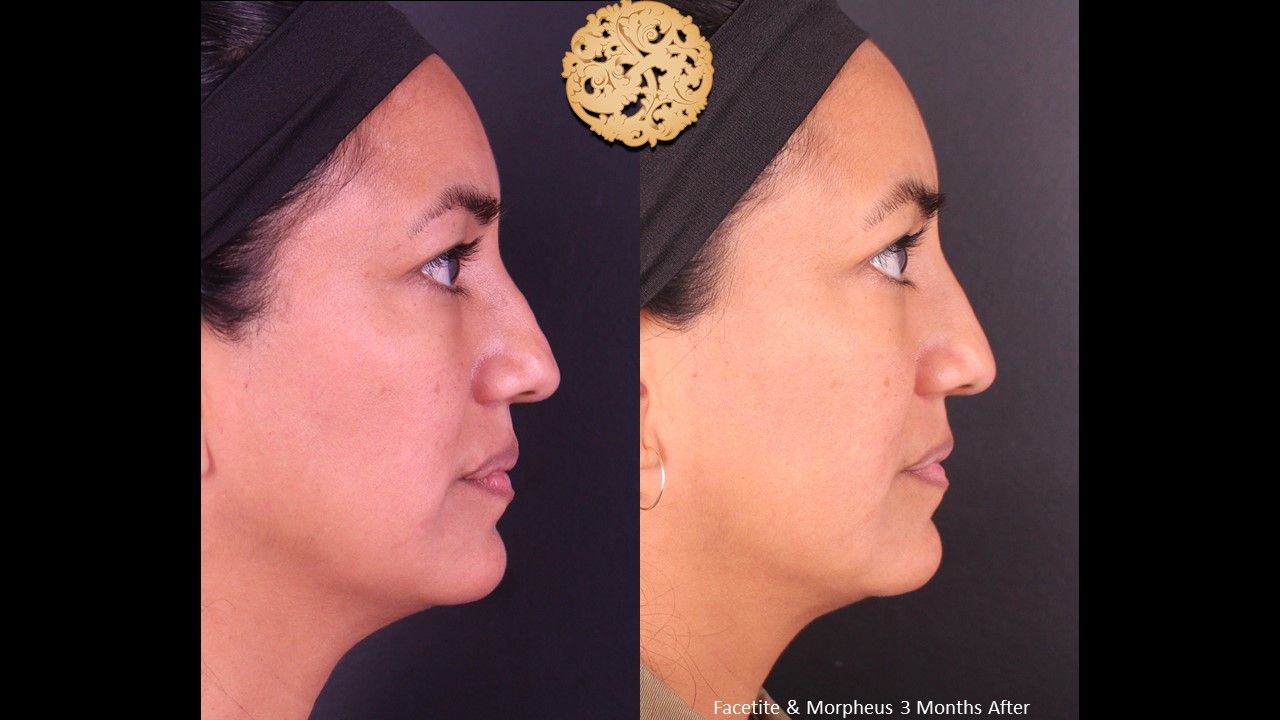 Morpheus8 Face Before & After