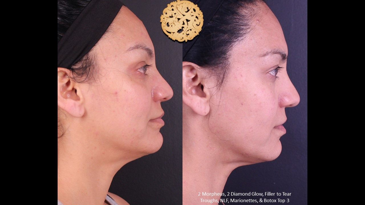 Morpheus8 Face Before & After