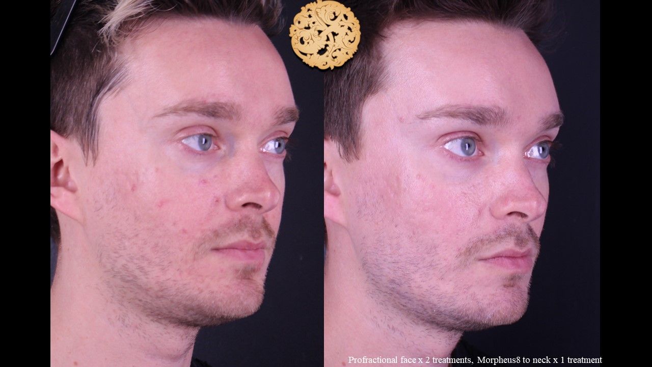 Morpheus8 Face Before & After