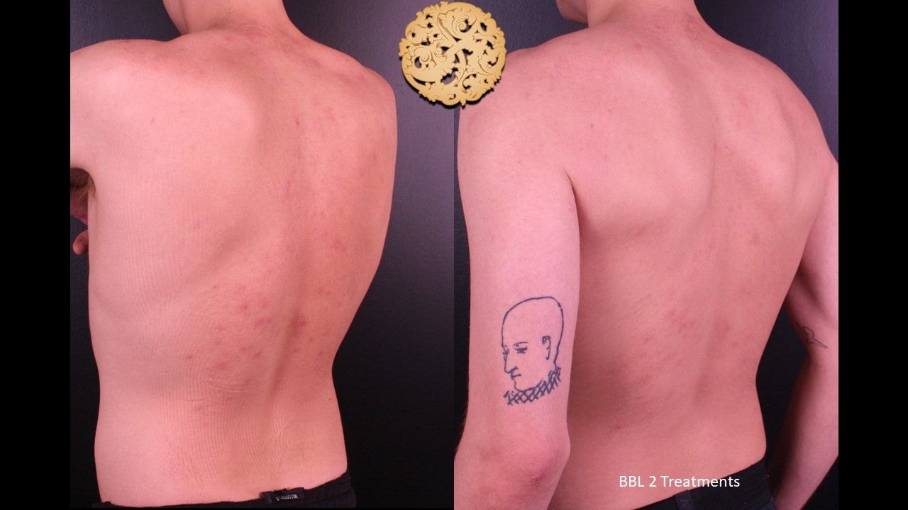 BBL Laser Pigmentation Before & After