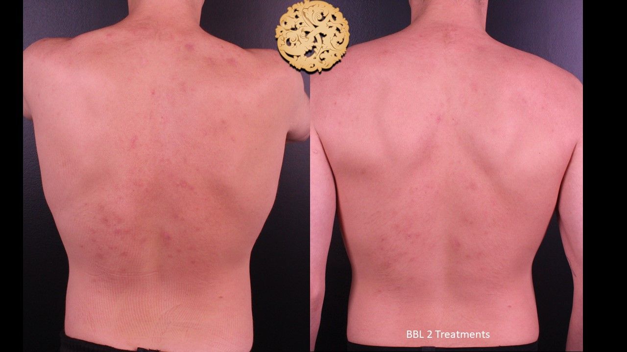 BBL Laser Pigmentation Before & After