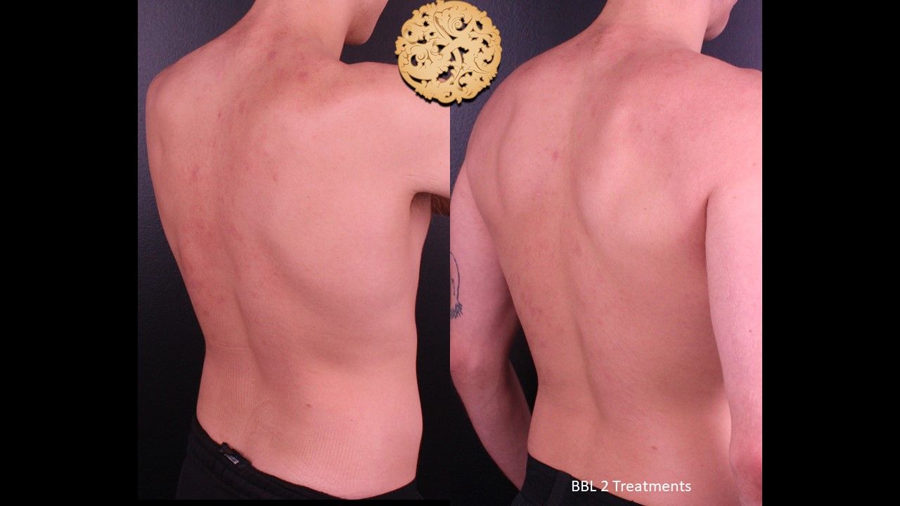 Bbl Laser Pigmentation Before & After