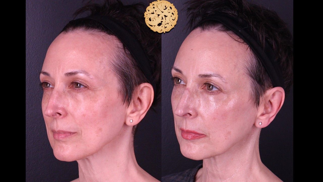 BBL Laser Pigmentation Before & After