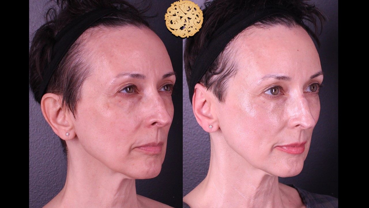 Bbl Laser Pigmentation Before & After