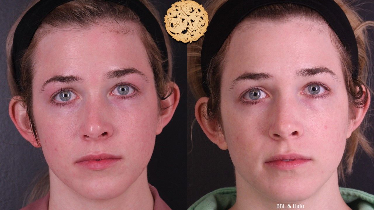 Bbl Laser Pigmentation Before & After