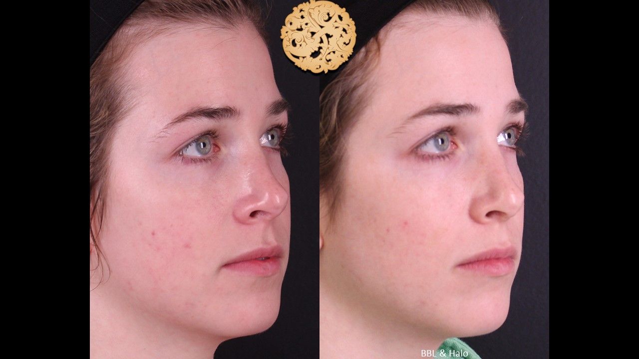 Bbl Laser Pigmentation Before & After