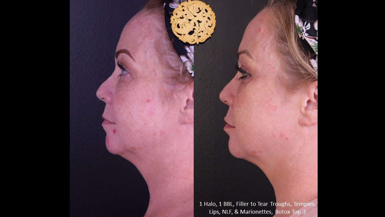 BBL Laser Pigmentation Before & After