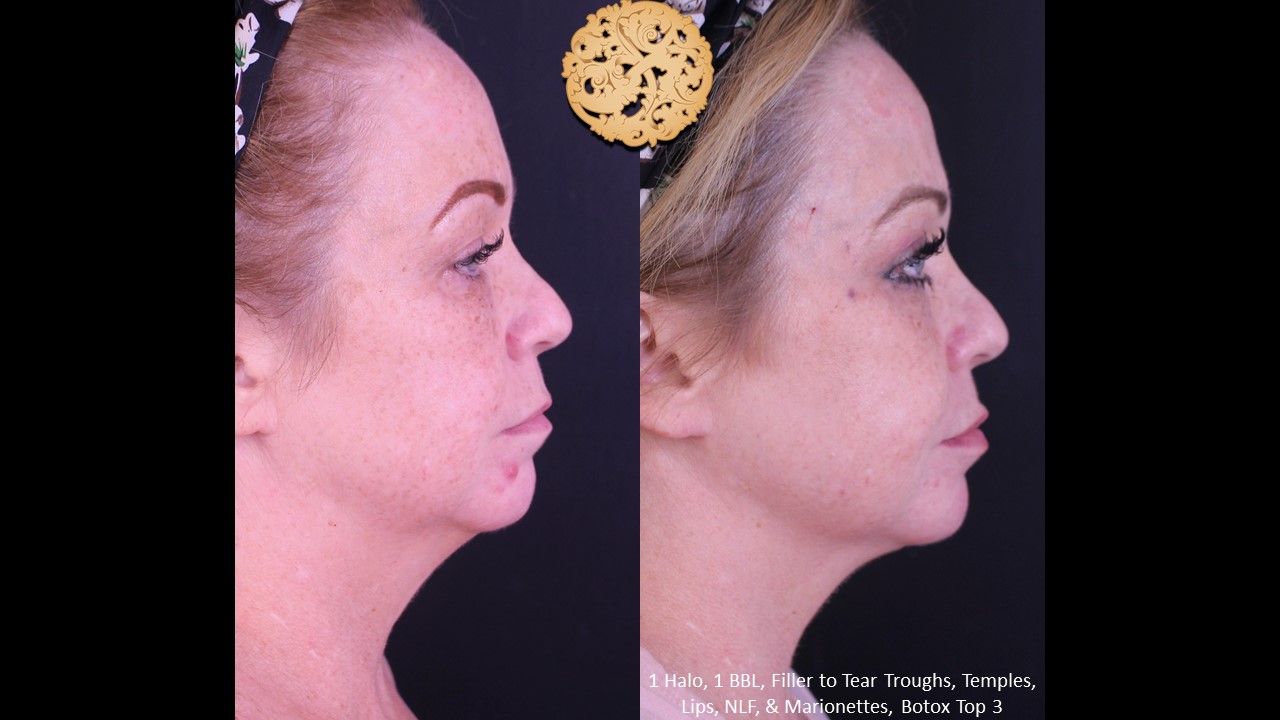 Bbl Laser Pigmentation Before & After