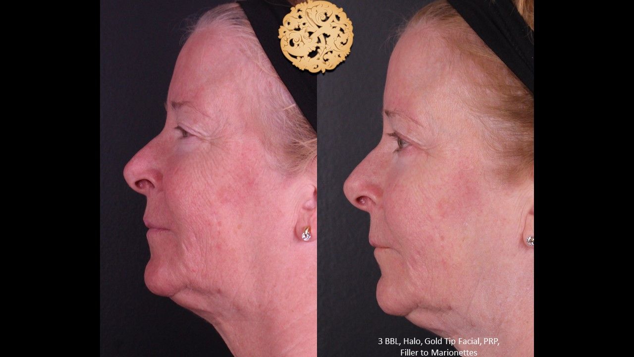 BBL Laser Pigmentation Before & After