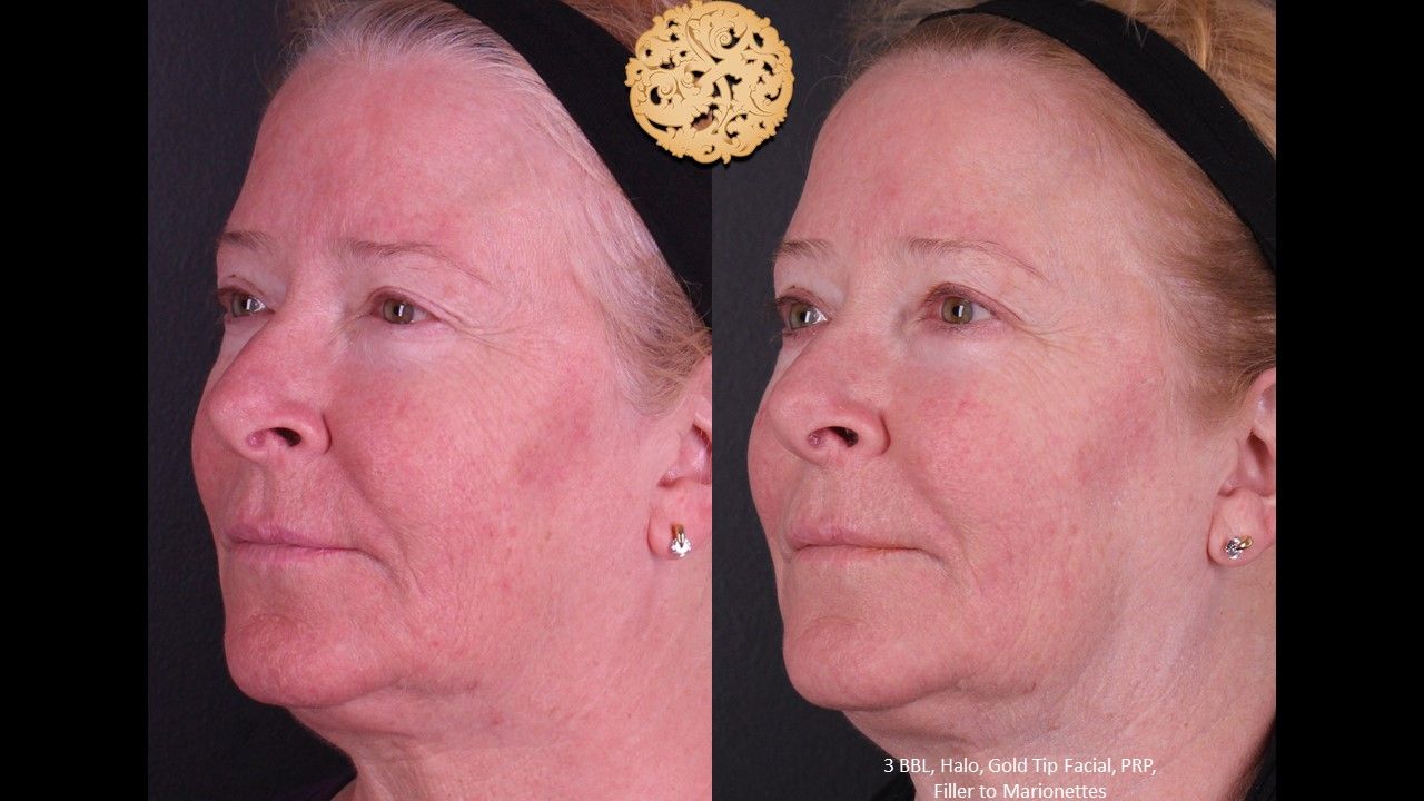 BBL Laser Pigmentation Before & After