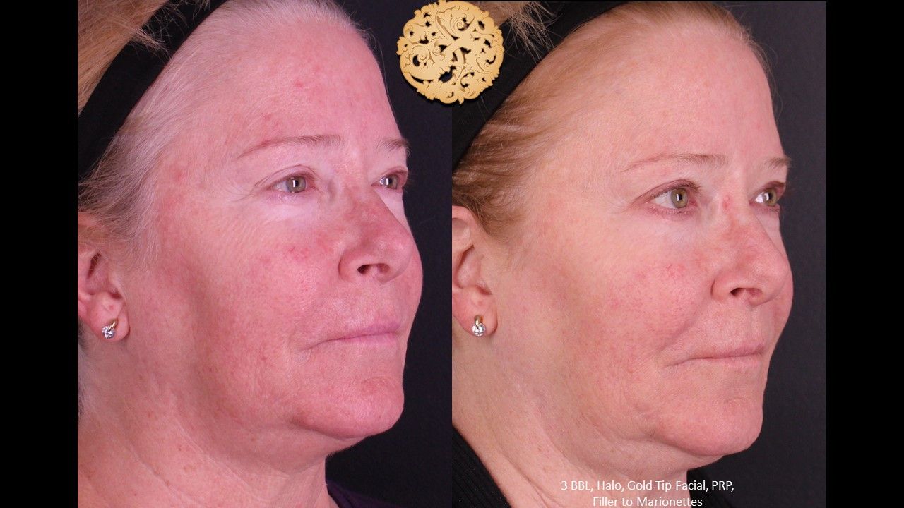 Bbl Laser Pigmentation Before & After