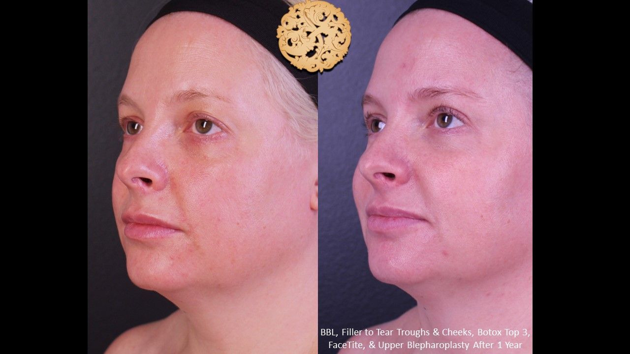 BBL Laser Pigmentation Before & After