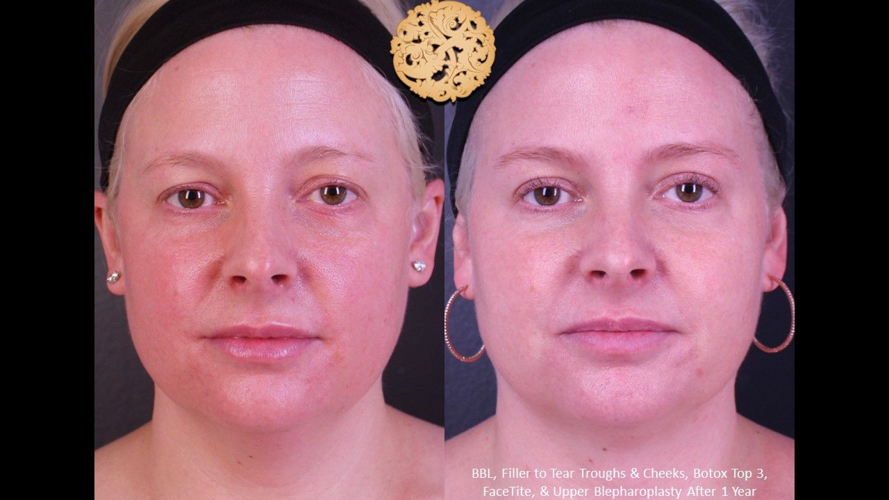 Bbl Laser Pigmentation Before & After
