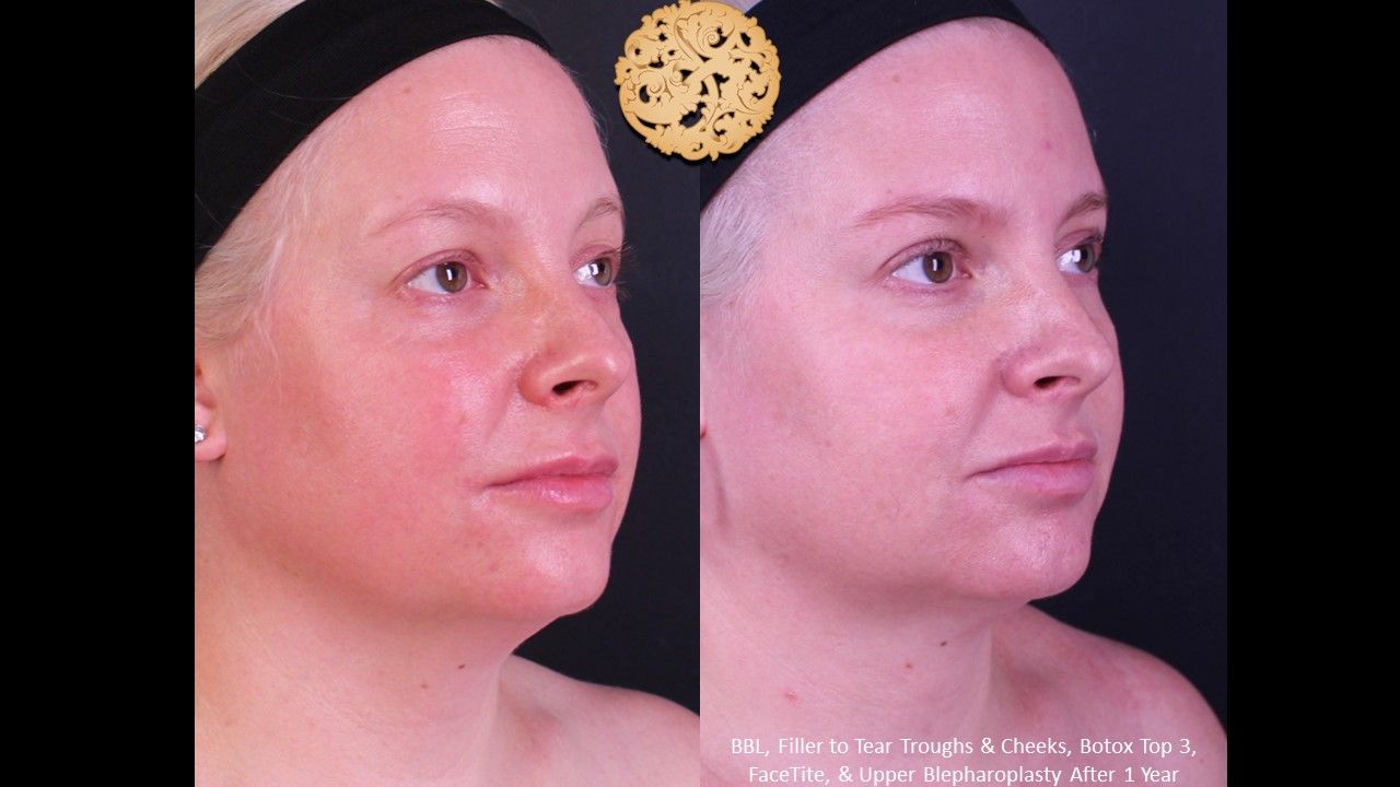 Bbl Laser Pigmentation Before & After