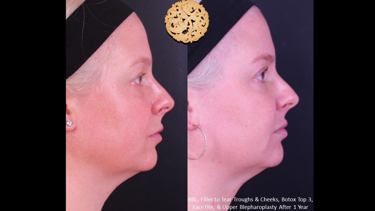 Bbl Laser Pigmentation Before & After