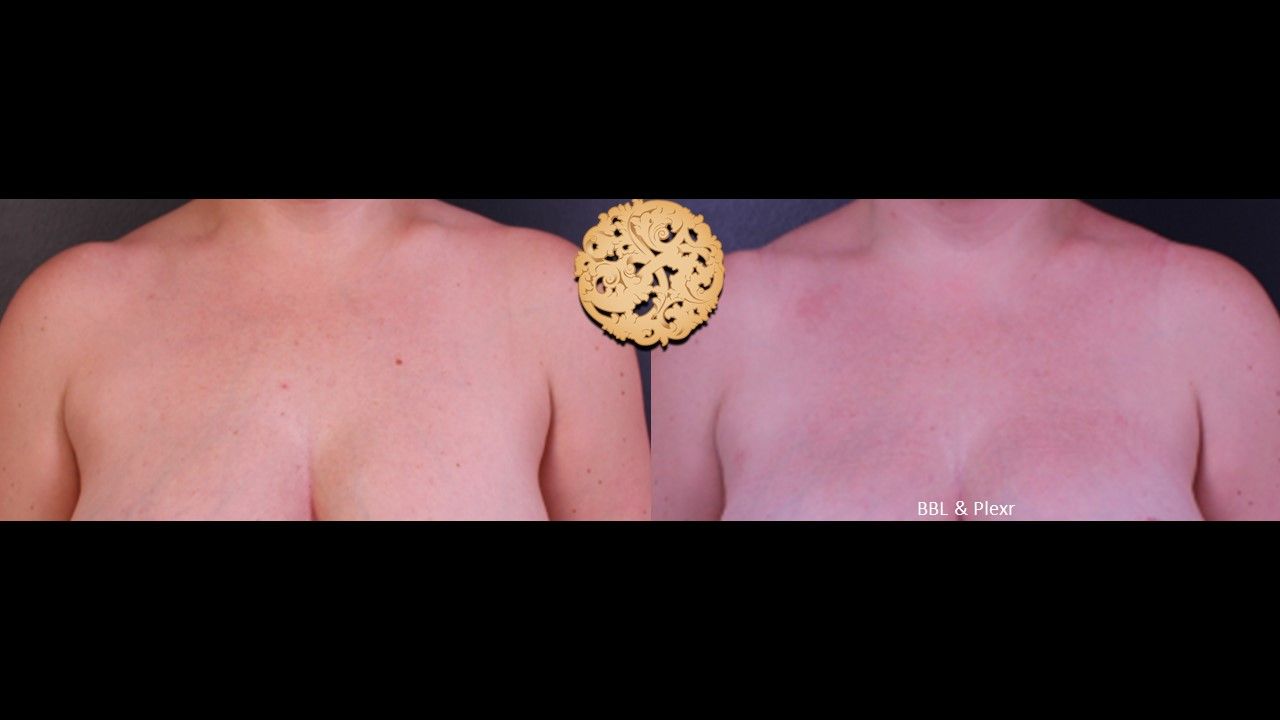 Bbl Laser Pigmentation Before & After