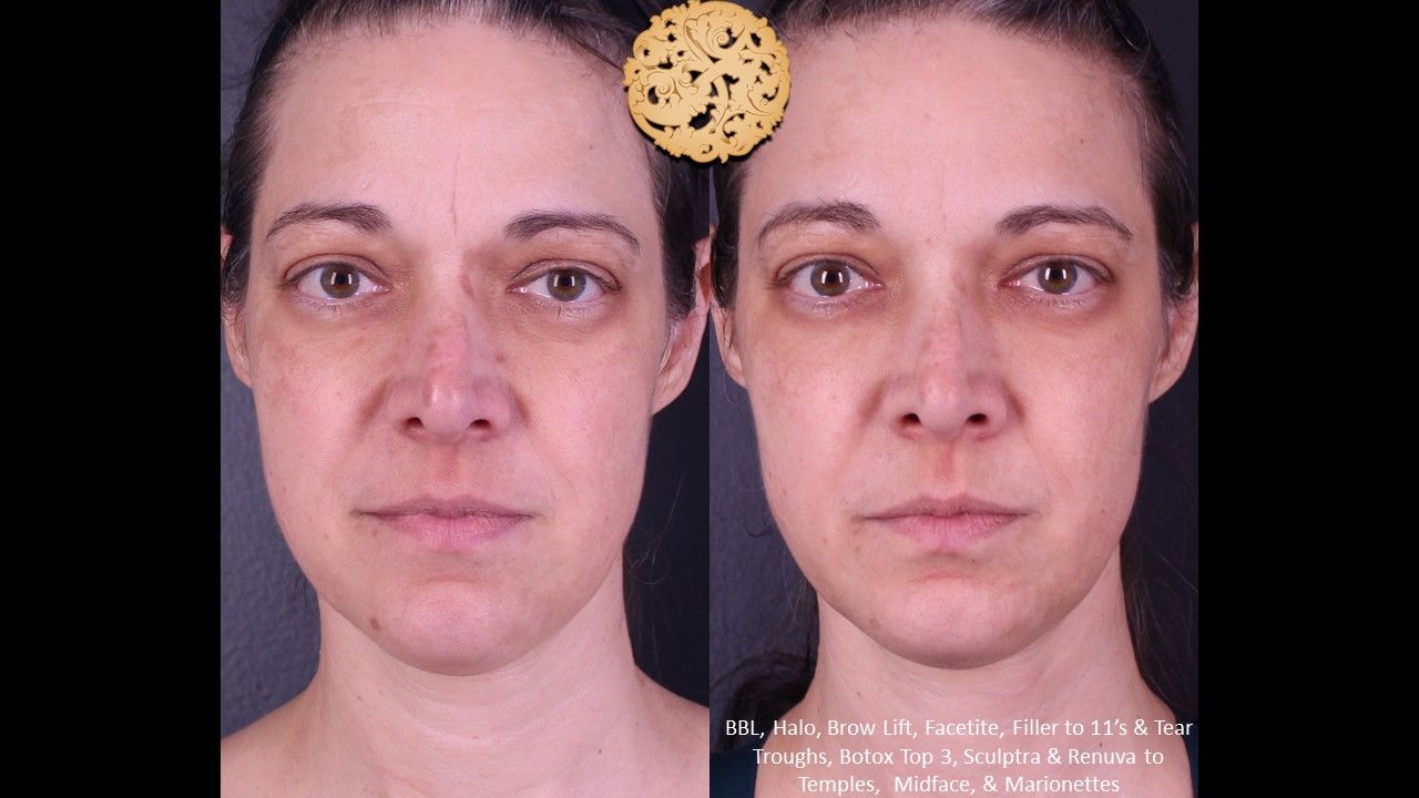 Bbl Laser Pigmentation Before & After