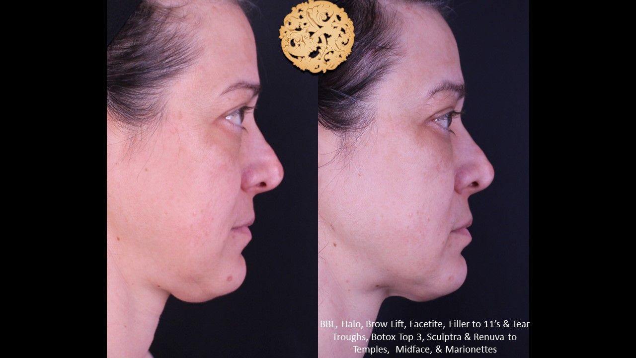 Bbl Laser Pigmentation Before & After