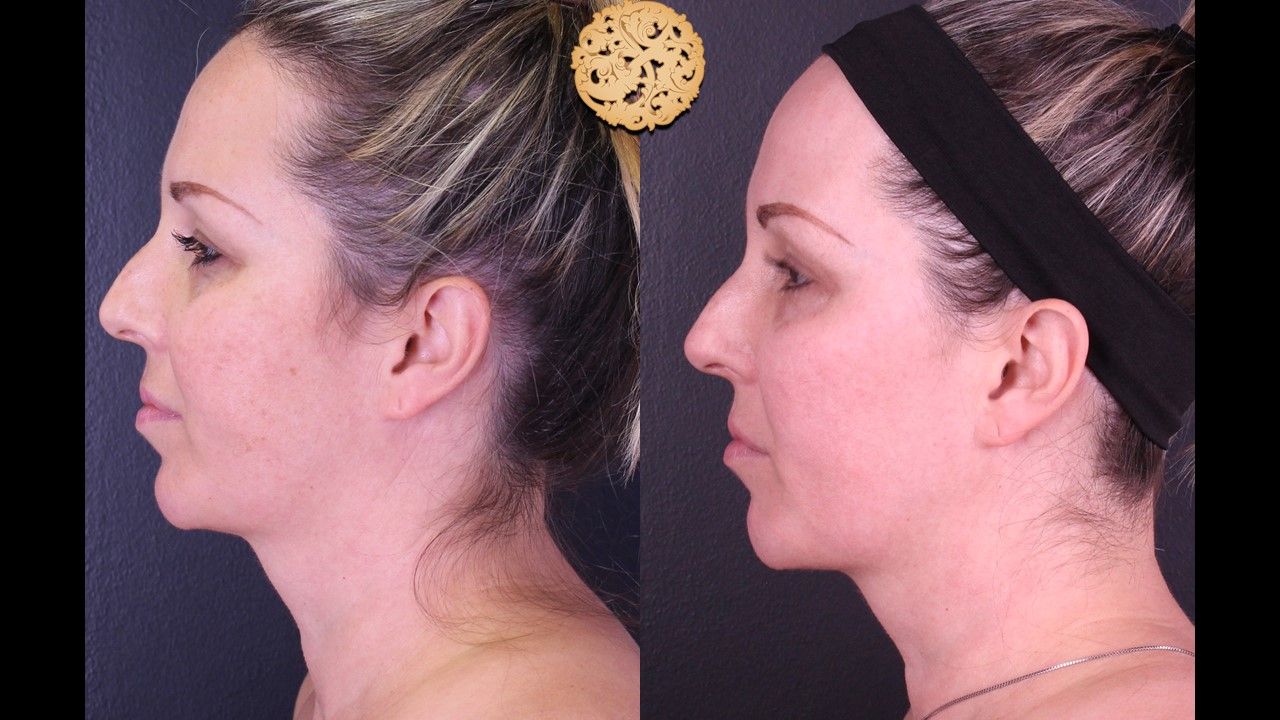 BBL Laser Pigmentation Before & After