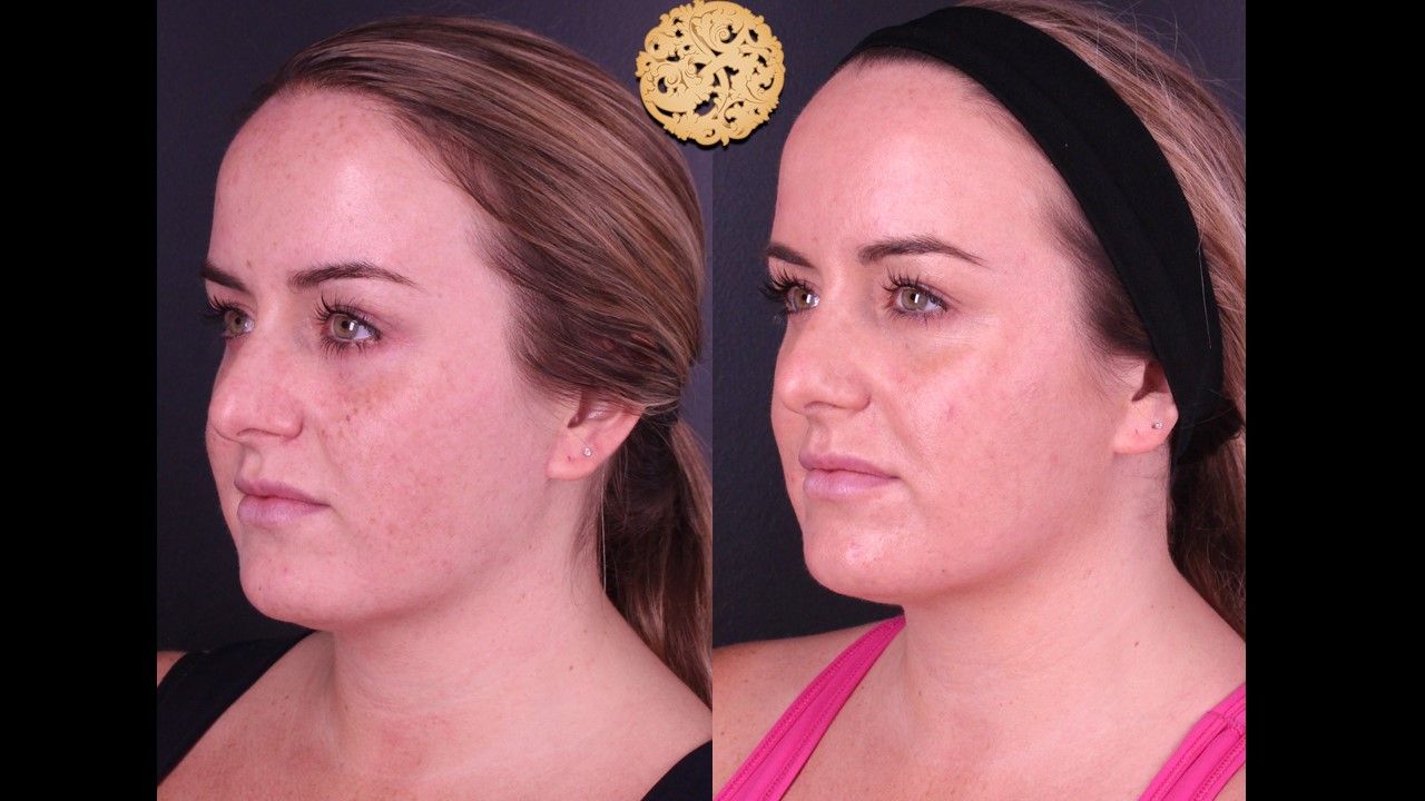 BBL Laser Pigmentation Before & After