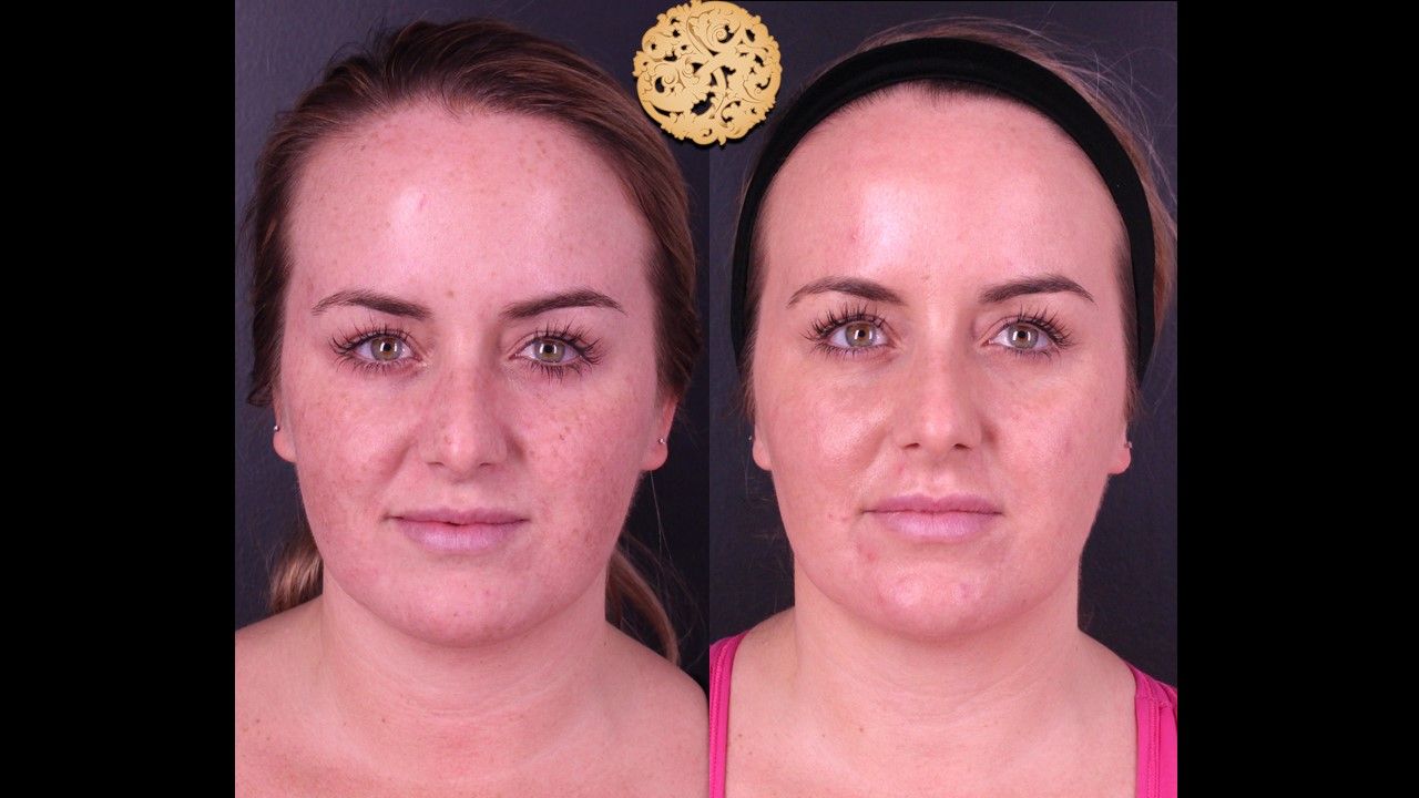 Bbl Laser Pigmentation Before & After