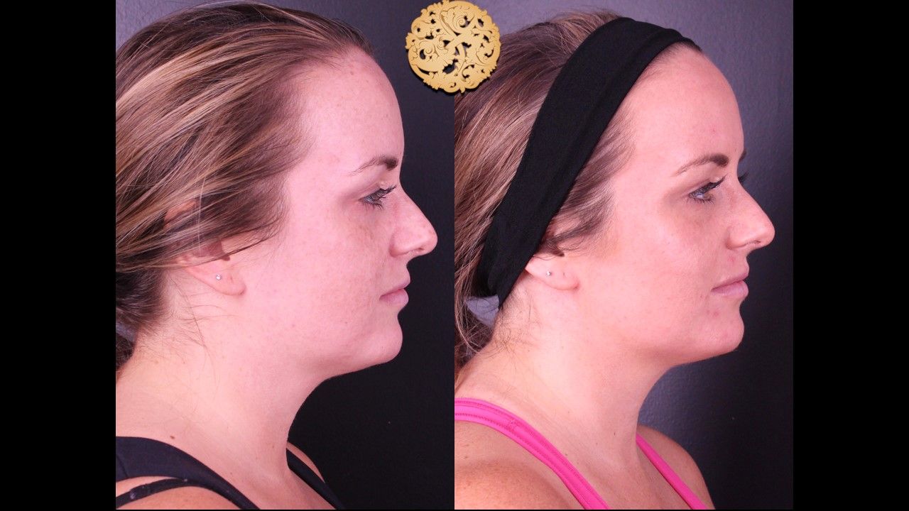 Bbl Laser Pigmentation Before & After