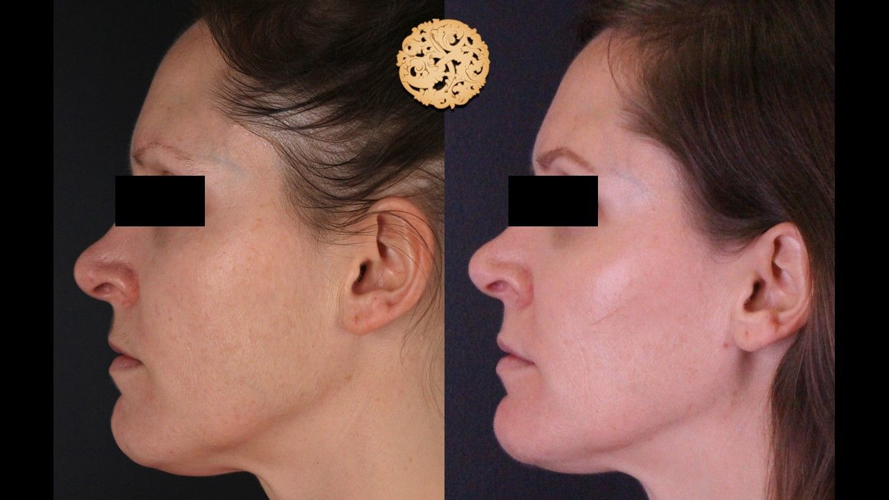 BBL Laser Pigmentation Before & After