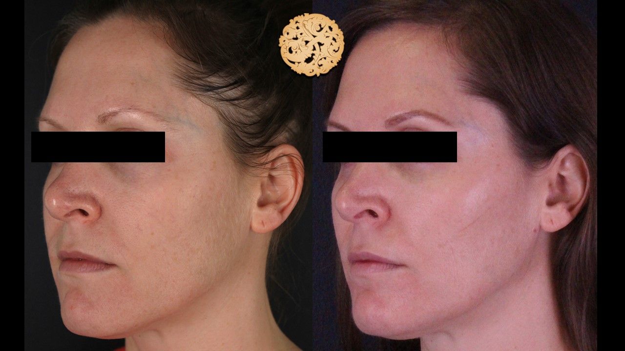 BBL Laser Pigmentation Before & After