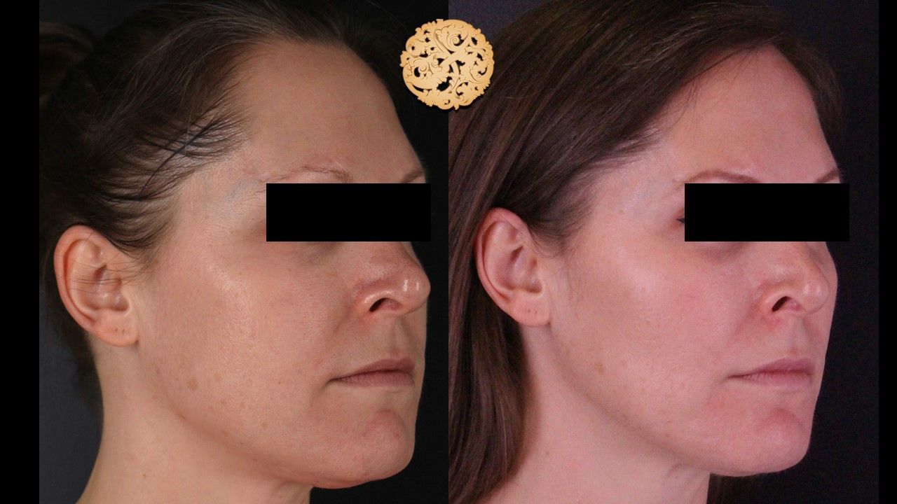 Bbl Laser Pigmentation Before & After