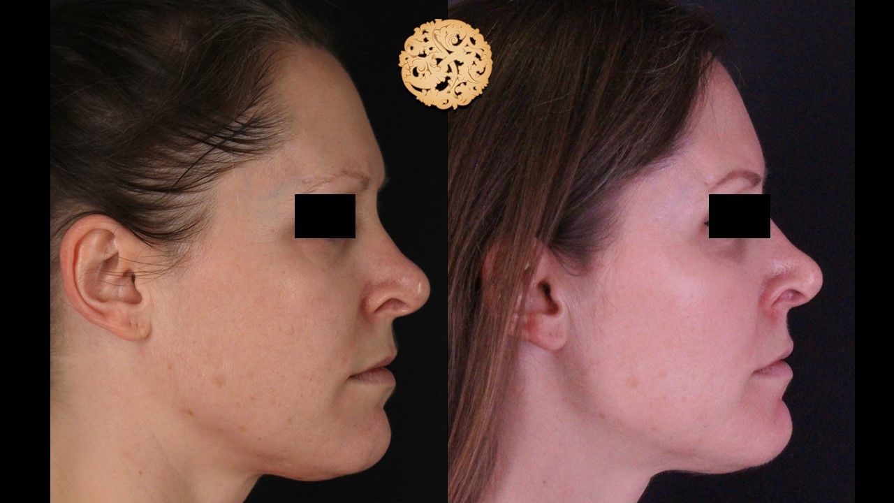Bbl Laser Pigmentation Before & After
