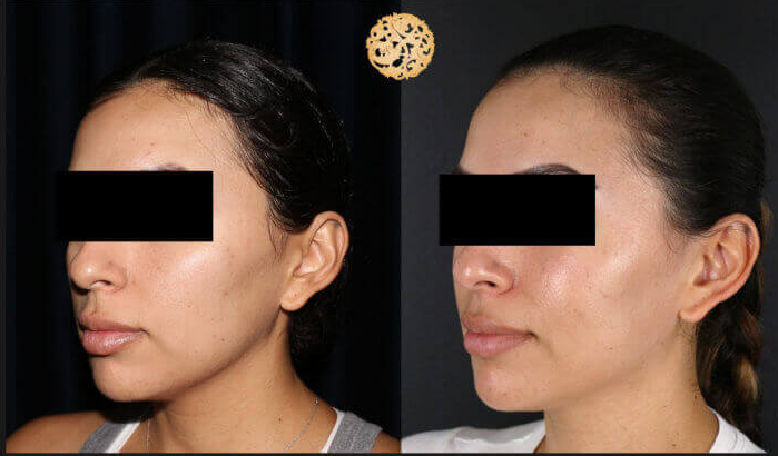 BBL Laser Pigmentation Before & After
