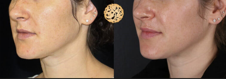 BBL Laser Pigmentation Before & After